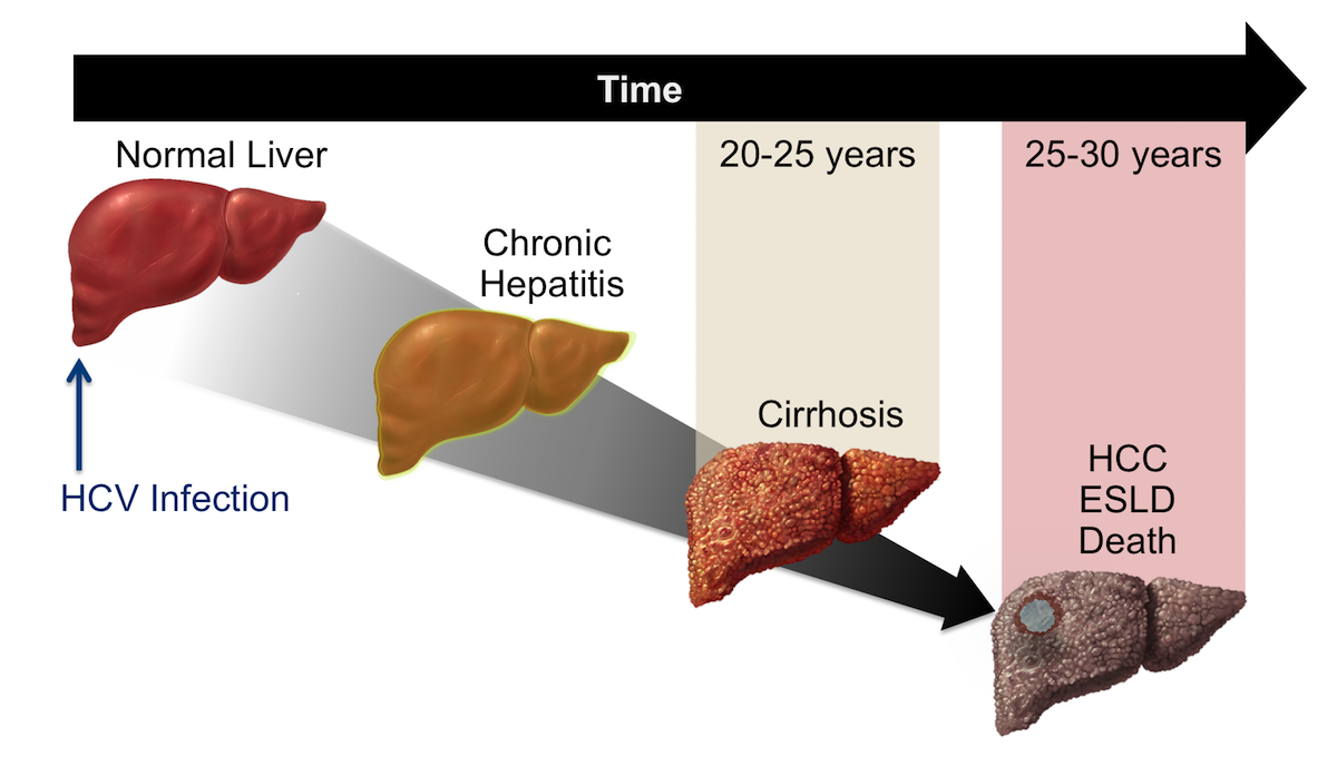 hepatitis-c-chronic-chronic-hepatitis-c